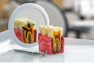 Root Canal Treatment