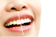 Tooth Whitening